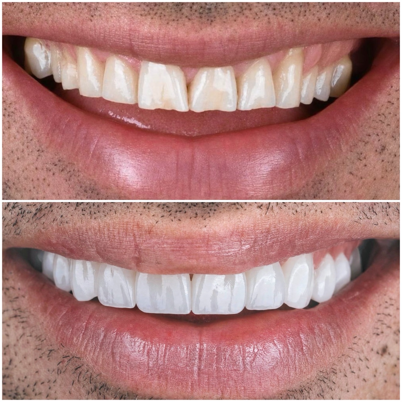 Case 28 — Lip Support Restored