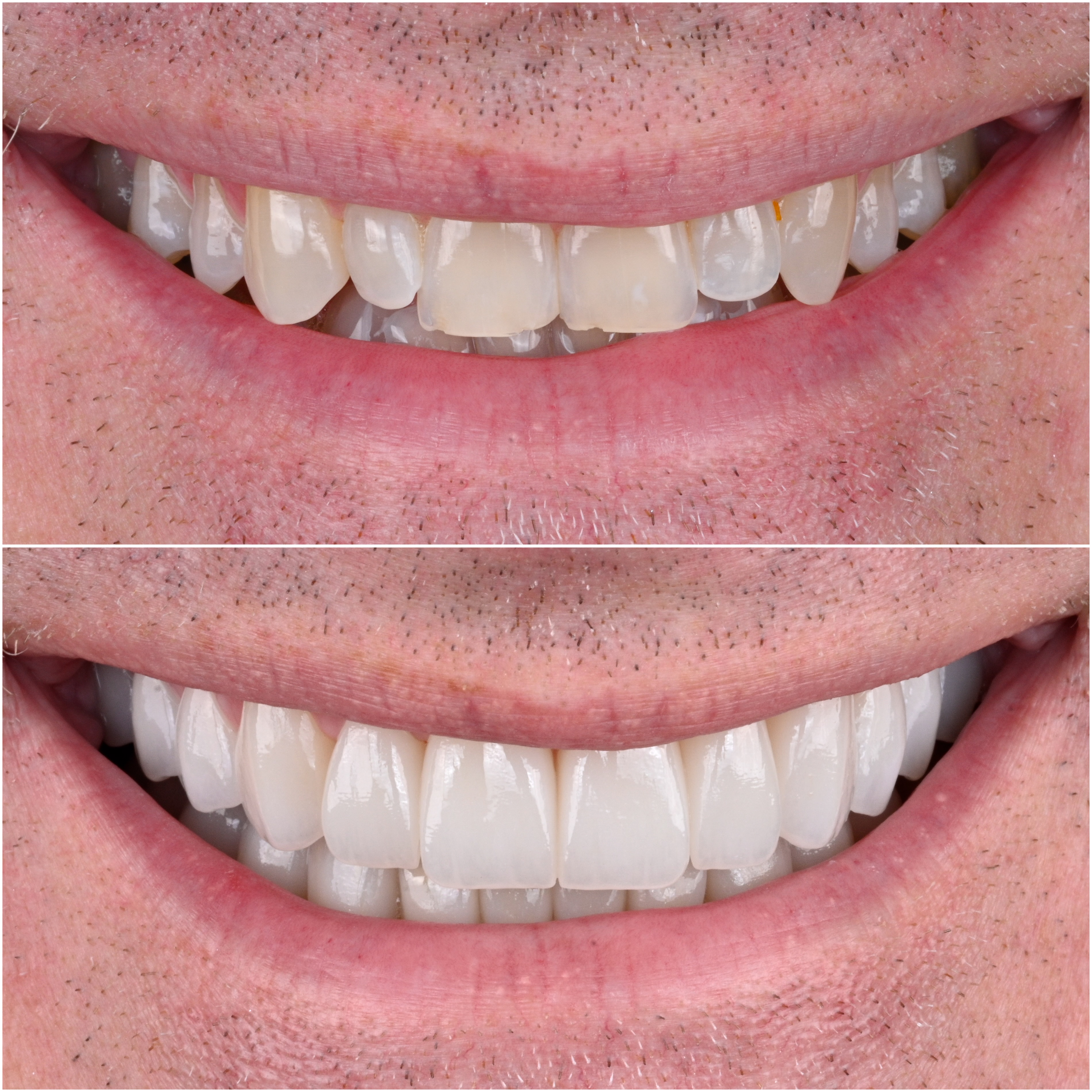 Case 31 — Full Arch Balance