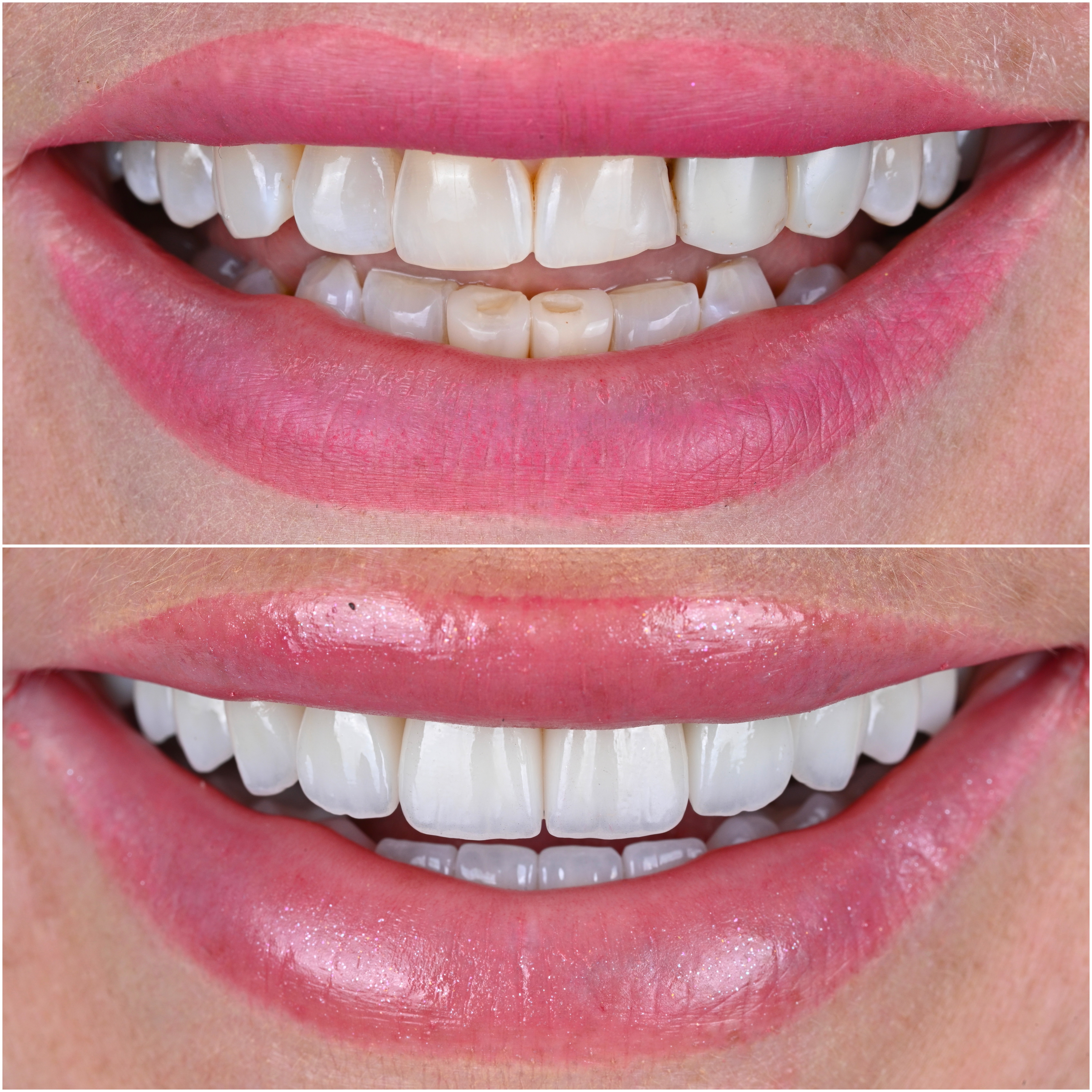Case 32 — Occlusal Esthetic Reset